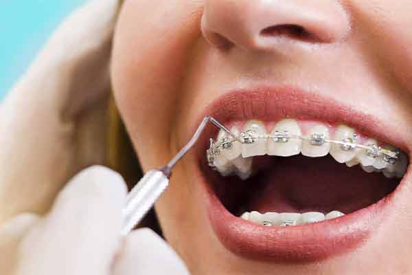 Dental Braces and Bonding Service in Rohini