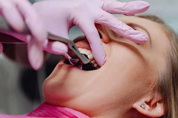 Dental Extractions & Gum Surgery Service in Rohini