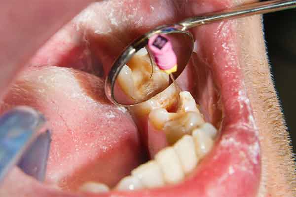 Dental Root Canal Service in Rohini