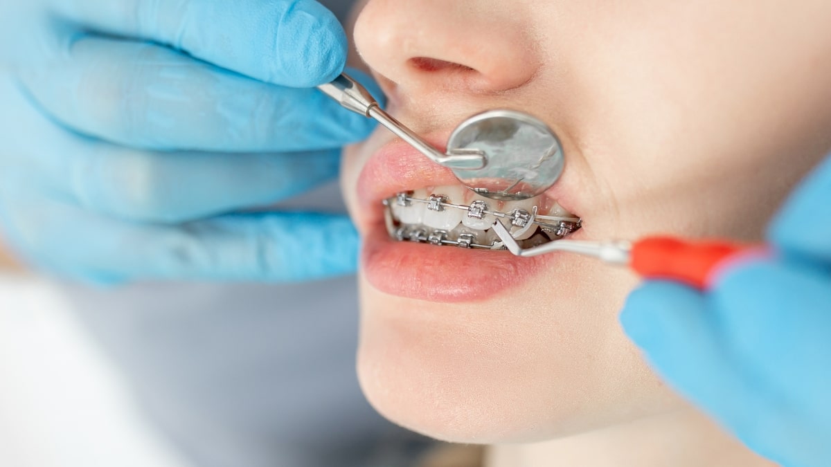 How Long Does It Take to Straighten Teeth