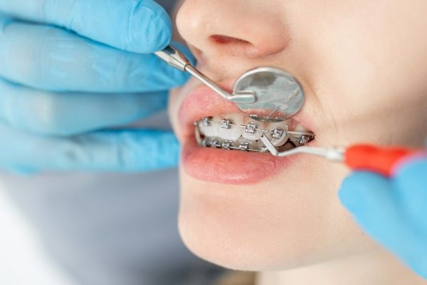 How Long Does It Take to Straighten Teeth