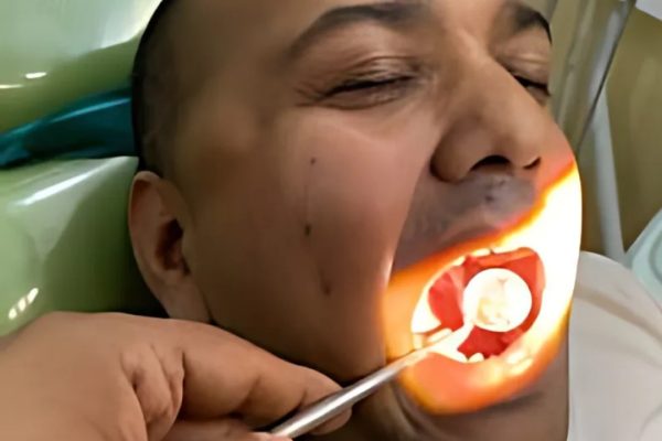 Teeth Scaling and whitening